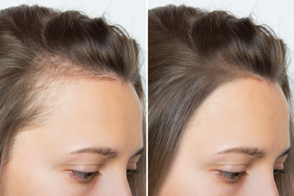 scalp micropigmentation
