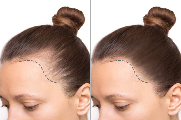 scalp micropigmentation