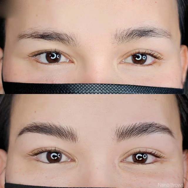 brow enhancement